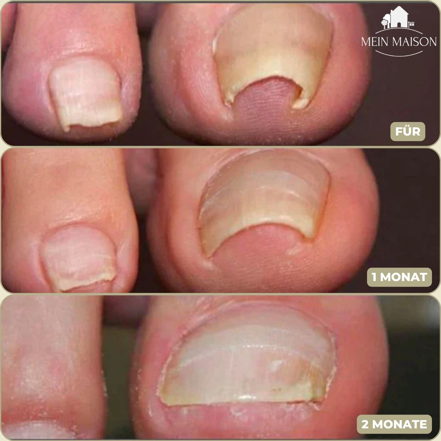 10+10 GRATIS | FixaNail - Sofortige Nagelreparatur